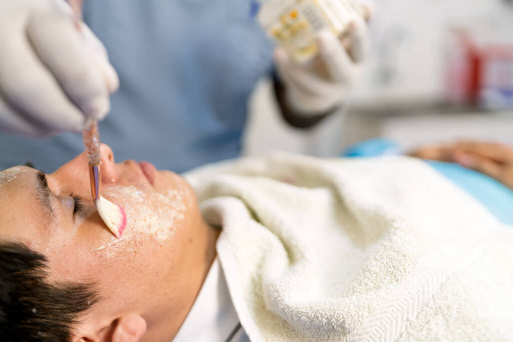 Efekty peelingu migdałowego w Bydgoszczy - gładka cera bez niedoskonałości i rozjaśnienie przebarwień Gładka cera Bydgoszcz